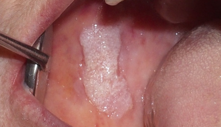 old-age dental problems,common dental issues for seniors,dry mouth solutions for elderly,missing teeth remedies,gum disease prevention for seniors,fungal infections in elderly,oral care tips for older adults,managing dental health in seniors,geriatric dental care tips,dental health for elderly