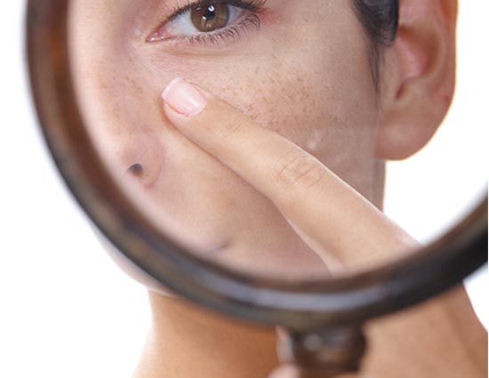 5 Home Remedies to Say Bye Bye to Open Skin Pores