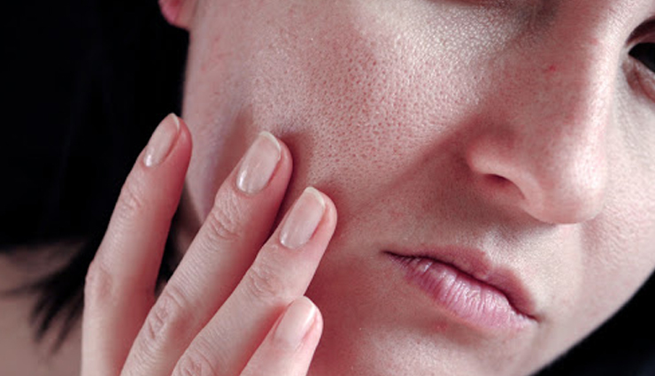 10 Effective Remedies To Treat Open Pores at Home