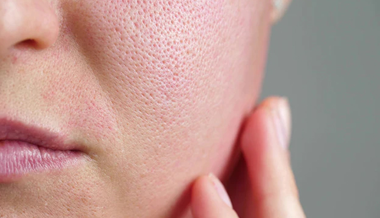 6 Natural Remedies to Treat Open Skin Pores at Home