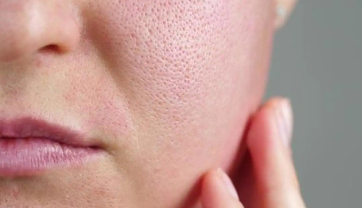 10 Home Remedies To get Rid of Large and Open Pores
