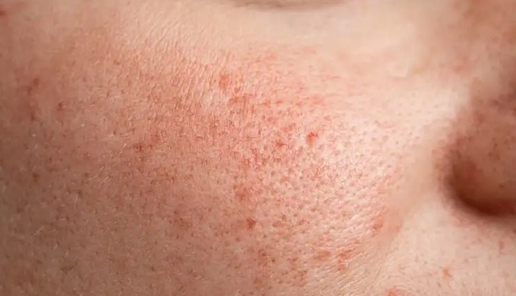 witch hazel skin benefits,skincare with witch hazel,reduce puffiness,combat acne with witch hazel,heal bruises naturally,minimize open pores,treat varicose veins,soothe sunburn,affordable skincare solutions,witch hazel oil benefits