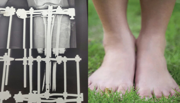 सात समंदर पार तक बजा राजस्थान के SMS हॉस्पिटल का डंका, सिर्फ डेढ़ लाख में 2 ऑपरेशन कर 15cm बढ़ाई अमेरिकी युवती की हाईट