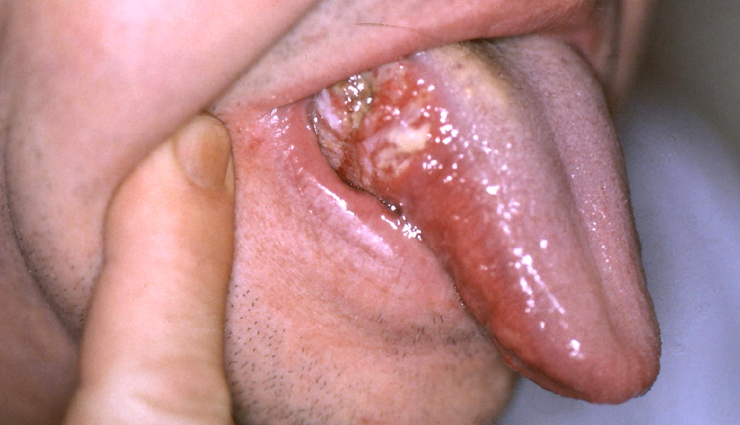 common mouth problems,tongue issues,dental hygiene,oral health concerns,mouth and tongue conditions,dental caries prevention,periodontal disease prevention,amalgam tattoo,halitosis treatment,black hairy tongue causes,canker sore remedies,tooth decay prevention,tooth abscess treatment,cold sore management,chipped tooth repair,leukoplakia diagnosis,lichen planus symptoms,thrush treatment,oral cancer detection,dry mouth remedies