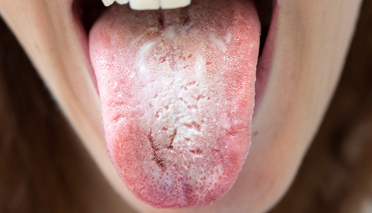 5 Remedies To Treat Oral Thrush Naturally