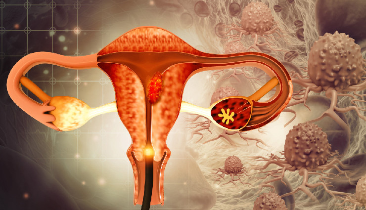 Major Symptoms, Precautions and Treatment of Ovarian Cancer