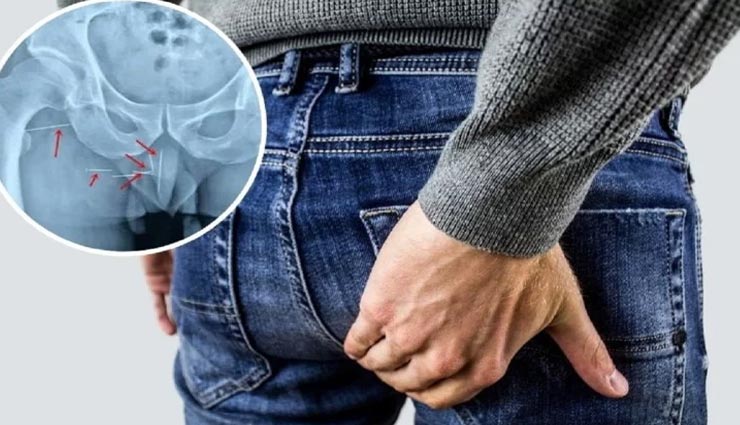 10 साल से पिछवाड़े में दर्द से परेशान था शख्श, एक्स-रे रिपोर्ट देखकर डॉक्टर भी हुए हैरान