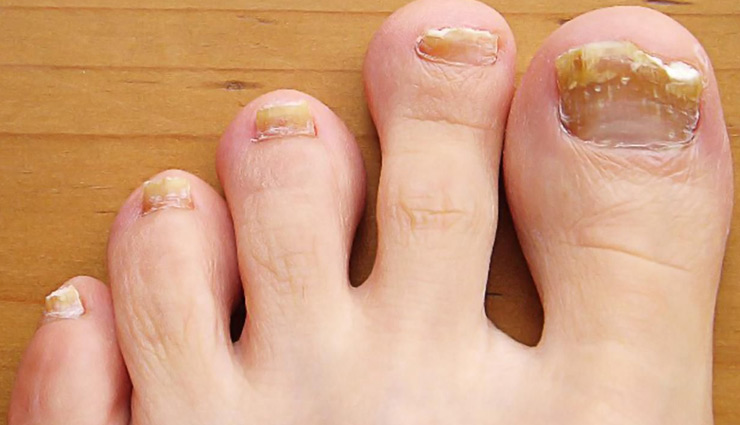पैर के नाखून का दर्द होता है असहनीय, आराम पाने के लिए करें ये उपाय leg nail pain,home remedies