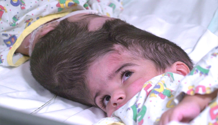 55 घंटे चले ऑपरेशन के बाद अलग की गईं सिर से जुड़ी बच्चियां, खुशी जाहिर करते हुए मां ने कही यह बात