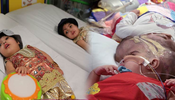 conjoined twin girls,pakistani twin girls,girls separated in london,after 50 hours of surgery,conjoined twins,safa and marwa,surgery,blood vessels,weird news,weird story,omg news ,पाकिस्तान,सिर से जुड़ी बच्चियां,अजब गजब खबरे हिंदी में