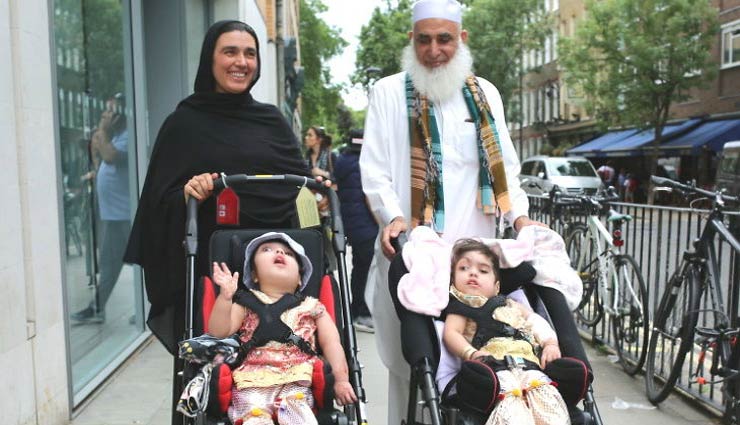 conjoined twin girls,pakistani twin girls,girls separated in london,after 50 hours of surgery,conjoined twins,safa and marwa,surgery,blood vessels,weird news,weird story,omg news