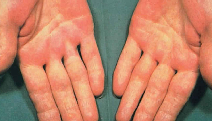 liver damage signs,skin abnormalities liver damage,blue rashes liver disease,skin itching liver damage,spider angioma liver dysfunction,halitosis liver impairment,palmar erythema liver damage,facial hyperpigmentation liver dysfunction,liver health warning signs,symptoms of liver damage