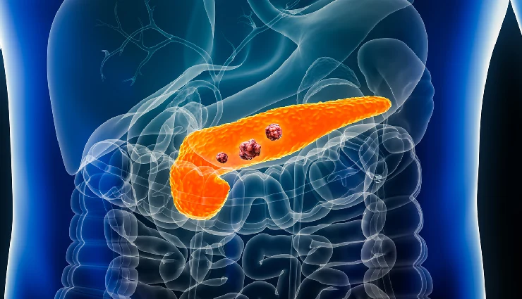 types of cancer,most common cancers,breast cancer,lung cancer,blood cancer,colon cancer,prostate cancer,cancer effects on body,causes of cancer,cancer risk factors,cancer fatality rate,cancer awareness,abnormal cell growth,cancer treatment,cancer impact on organs