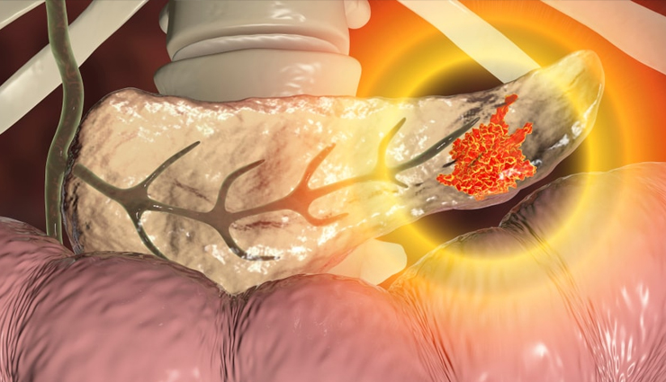 side effects of high vitamin d,vitamin d toxicity symptoms,hypercalcemia from vitamin d,kidney damage vitamin d,weak bones vitamin d overdose,irregular heartbeat vitamin d,lung damage vitamin d,dehydration vitamin d overdose,nausea from vitamin d,pancreatitis vitamin d