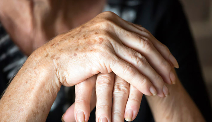 paronychia,home remedies,home remedies to treat paronychia,Health tips,fitness tips