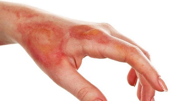 पटाखों से जलने पर जल्द करें ये उपचार, मिलेगा तकलीफ से आराम 