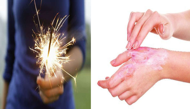 पटाखों से जलने पर जल्द करें ये उपचार, मिलेगा तकलीफ से आराम diwali special,Health tips,firecrackers,treatment,get relief from the pain,home remedies