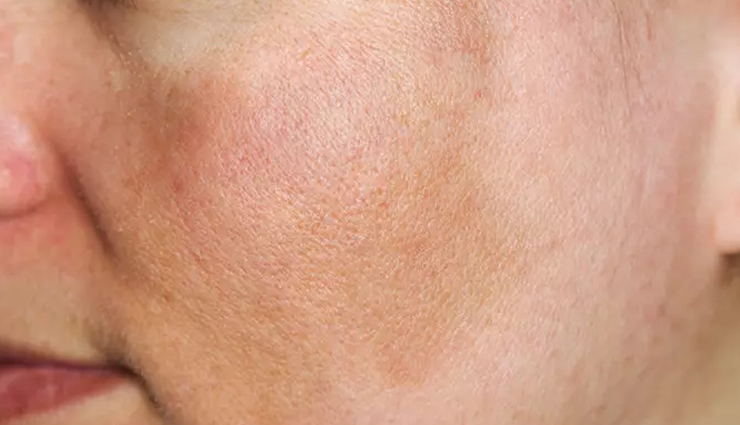 lemon juice skin side effects,risks of using lemon juice on skin,negative effects of lemon juice on skin,lemon juice for skin dangers,harmful impacts of lemon juice on skin,side effects of using lemon juice for skin lightening,precautions while using lemon juice on skin,lemon juice induced skin irritation,allergic reactions to lemon juice on skin,citric acid skin damage from lemon juice