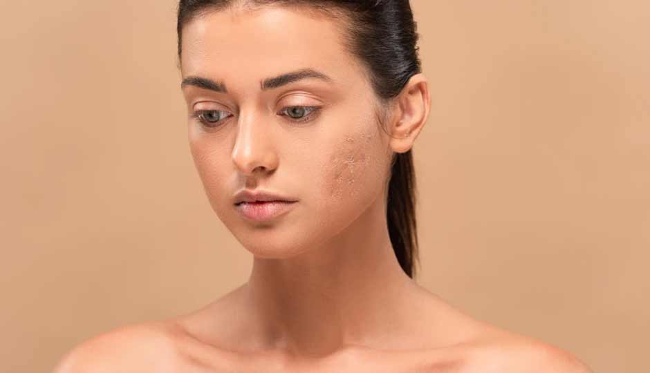 10 Home Remedies to Treat Patchy Skin