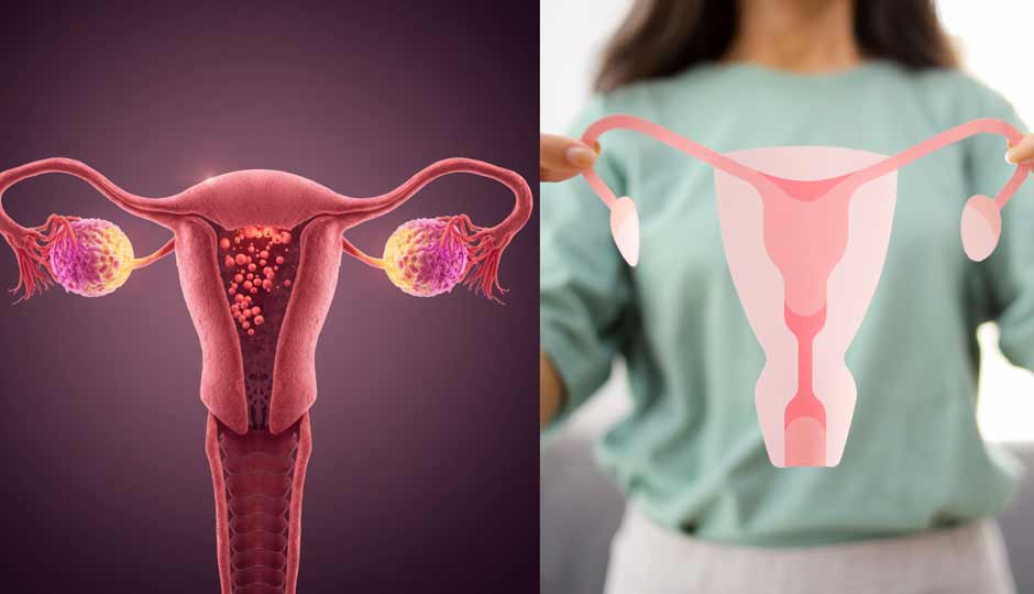 14 Home Remedies to Treat PCOD Naturally