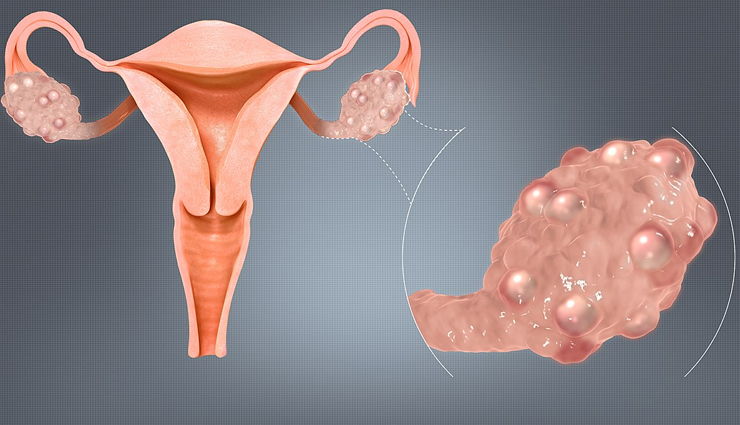 World Health Day- Effective Ayurvedic Treatment for PCOS