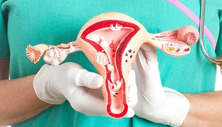 15 Home Remedies To Help You Treat PCOS