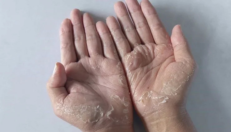 remedies to treat peeling skin,beauty tips,beuaty hacks