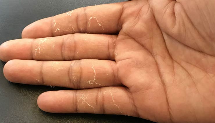 peeling fingertips,tips to get relief from peeling fingertips,Health tips,fitness tips