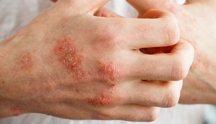 corn side effects,unexpected effects of corn,corn allergies,corn sensitivity,adverse reactions to corn,corn-related health issues,corn-induced symptoms,corn sensitivity reactions,corn intolerance,effects of excessive corn consumption