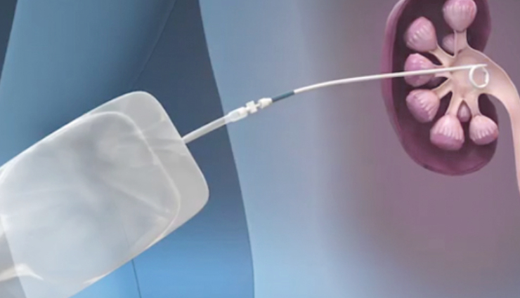 ways to treat kidney stones in children,kidney stones in children,pediatric kidney stones,symptoms of kidney stones in kids,causes of kidney stones in children,treatment options for pediatric kidney stones,hydration for kidney stone prevention,seeking medical attention for kidney stones,shock wave lithotripsy in children,cystoscopy for kidney stones,ureteroscopy in pediatric patients,percutaneous nephrolithotomy in children,pediatric kidney health,urinary system in children,nephrons function in kids,electrolyte regulation in pediatric kidneys,homeostasis in children,diagnostic testing for kidney stones,urinalysis for pediatric patients,imaging for pediatric kidney stones,non-invasive treatment for kidney stones,pediatric kidney stone prevention,child hydration for kidney health,pain relief for pediatric kidney stones,hematuria in children,postoperative discomfort in children,pediatric surgical procedures,minimally invasive surgery for children,risks and benefits of pediatric kidney stone treatments,pediatric urology care,parental support for children with kidney stones