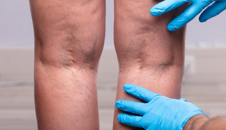 बैड कोलेस्ट्रॉल बढ़ने का ये संकेत दिखते ही हो जाएं सतर्क, नहीं तो जाना पड़ सकता है अस्पताल high cholesterol,cholesterol signs,cholesterol risk factors,cholesterol effects on the body,cholesterol symptoms,cholesterol cramps,peripheral artery disease and cholesterol,hypercholesterolemia,cholesterol levels,ldl cholesterol,hdl cholesterol,cholesterol management,cholesterol reduction,cholesterol-lowering foods,elevated cholesterol signs,cholesterol warning signs,high cholesterol indicators,cholesterol-related symptoms,silent cholesterol symptoms,cholesterol and fatigue,cholesterol and dizziness,cardiovascular risks of high cholesterol,heart disease and cholesterol,atherosclerosis and cholesterol,stroke risk and high cholesterol,cholesterol impact on arteries,organ damage from high cholesterol,cholesterol medications,lifestyle changes for cholesterol control,exercise for cholesterol management,diet for high cholesterol,preventing peripheral artery disease,medications for peripheral artery disease