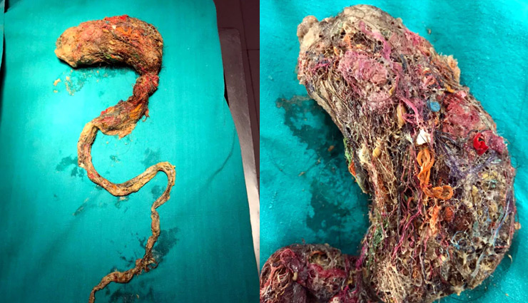 कोटा : 5 साल के बच्‍चे के पेट से निकली 3 फीट लंबी सांप जैसी गांठ, देख डॉक्टरों के उड़े होश 