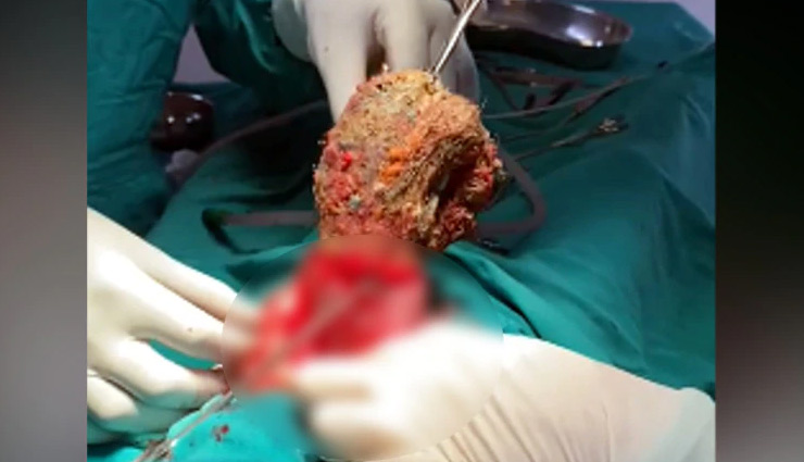 rajasthan,kota,doctor,weird news,3 foot long lumps,weird news