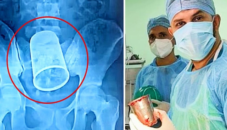 बिहार: लड़के के पेट से निकला 5.5 इंच लंबा स्टील का गिलास, देख डॉक्टर्स के उड़े होश
