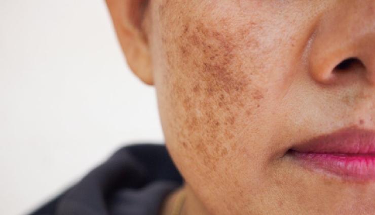 7 Home Remedies To Treat Pigmentation