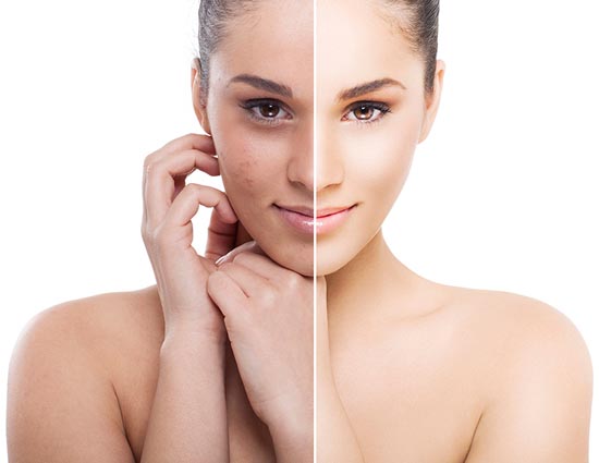 5 Ways To Get Rid of Pigmentation