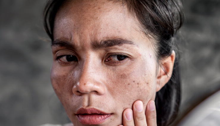 4 Home Remedies To Reduce Pigmentation