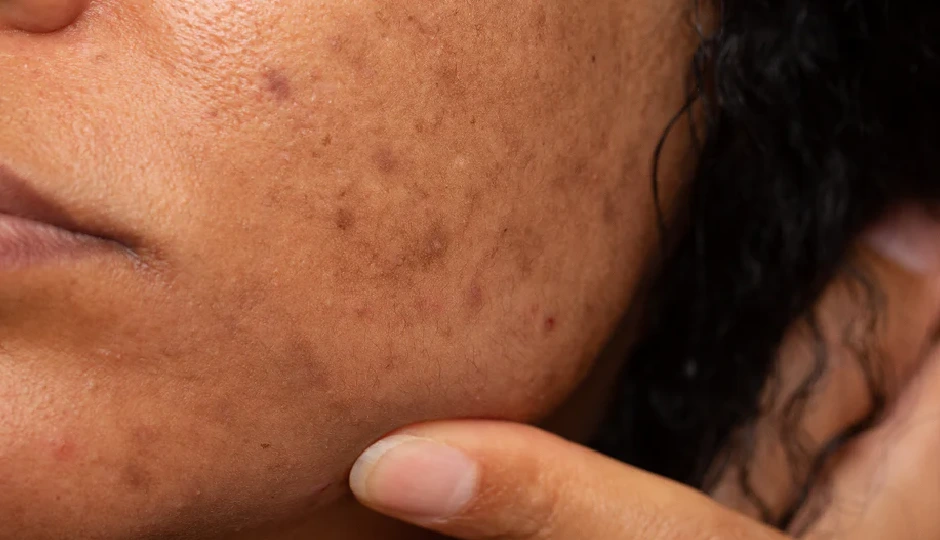 मुलेठी फेस पैक से करें पिगमेंटेशन का इलाज, पाएं बेदाग निखरी त्वचा