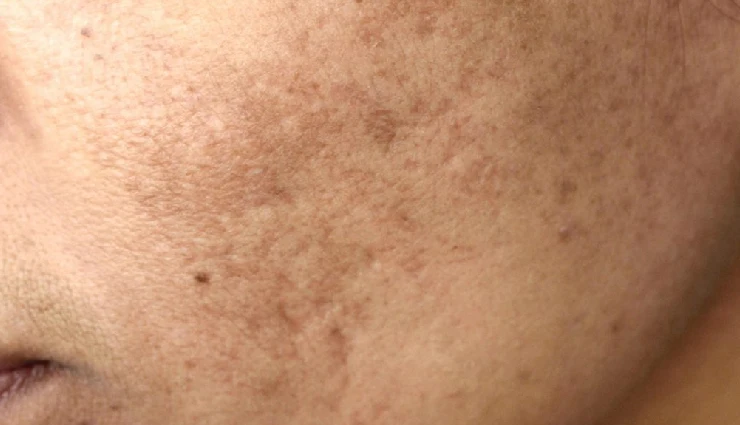 benefits of amla for skin and hair,amla for glowing skin,amla for acne and pigmentation,amla natural anti-ageing remedy,amla for dandruff control,amla for strong hair roots,amla for hair growth,amla to prevent grey hair,amla powder for beauty care,diy beauty remedies with amla