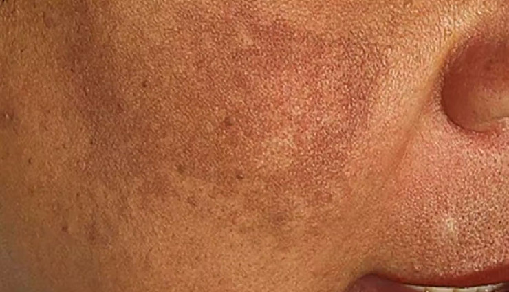 6 DIY Ways To Help You Cover Pigmentation