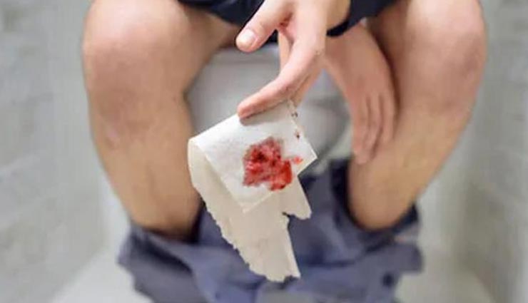 ये 6 आयुर्वेदिक नुस्खे बनते हैं बवासीर का काल, करते है इसे जड़ से समाप्त piles,what is piles,bawaseer ka ilaj,kaise kare bawaseer ka ilaj,bawaseer,home remedies for bawaseer,piles in hindi,health benefits,Health tips