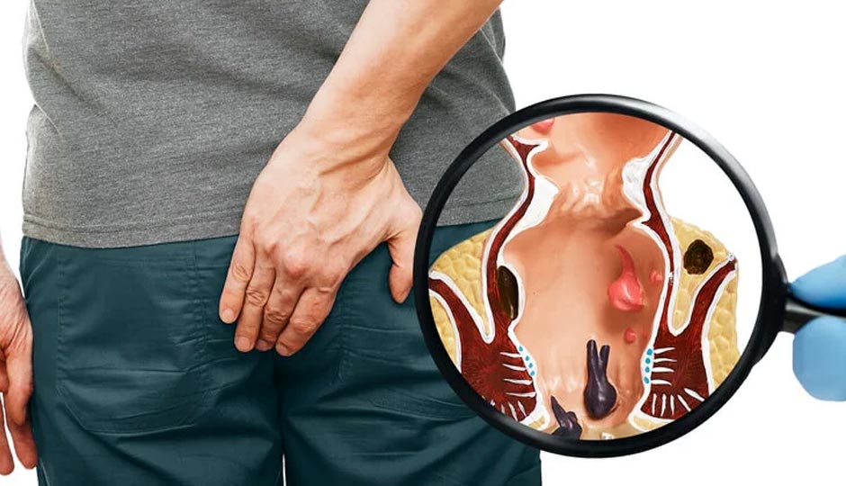8 Home Remedies To Treat Piles