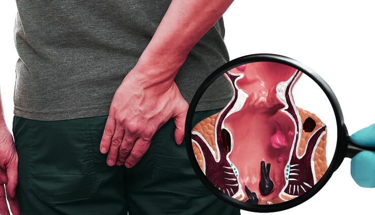 Understanding Piles: Causes and 7 Effective Home Remedies