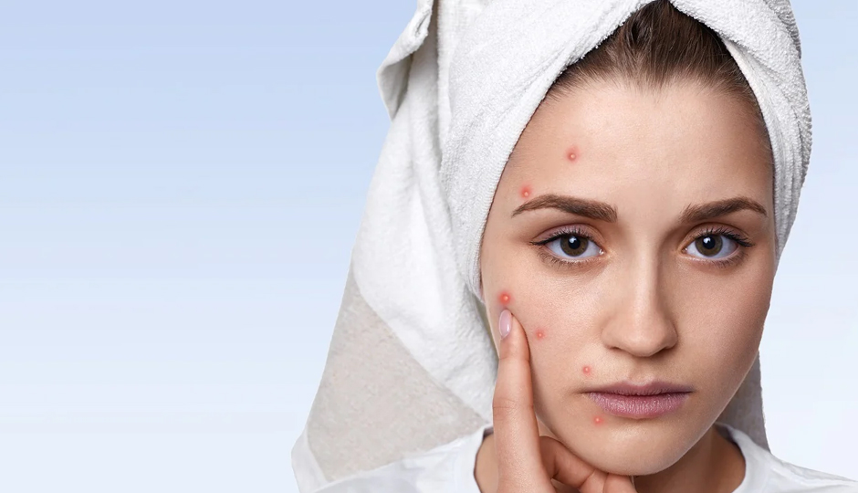 10 DIY Ways To Treat Pimples