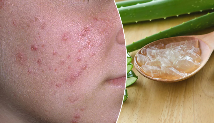 home remedies for skin problems,natural remedies for skin,treat skin issues at home,effective skin care remedies,oily skin treatment,dry skin remedies,anti-aging skin care,pimple and acne treatment,skin burn remedies,blackheads and whiteheads removal,unwanted hair removal,damaged skin healing