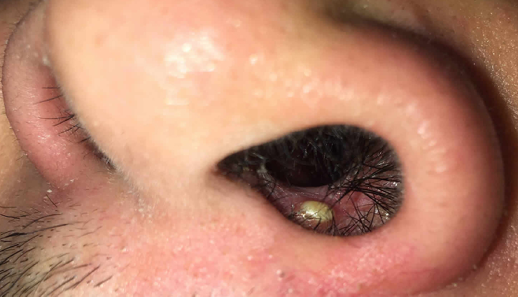 8 Home Remedies To Treat Pimple Inside The Nose