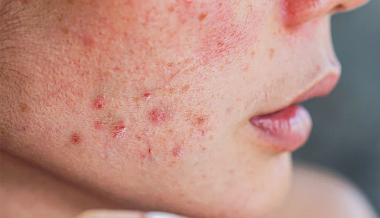 5 Natural Ways To Get Rid of Pimple Marks