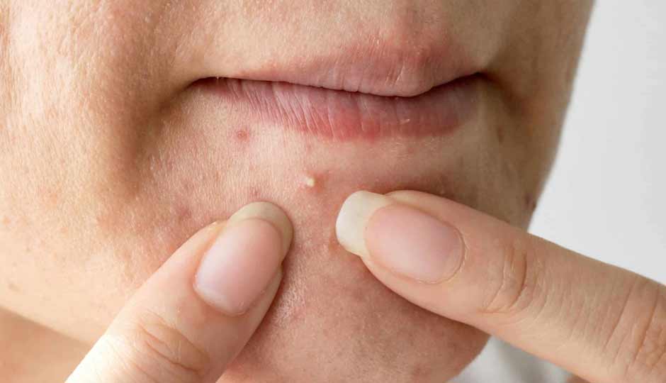 16 Home Remedies to Treat Pimples on the Chin Naturally