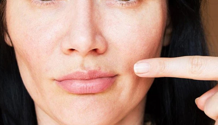 5 Natural Ways To Treat Pimples on Lips