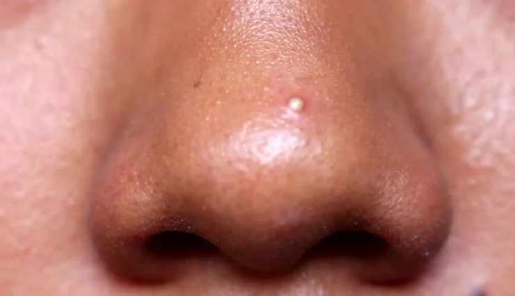 6 DIY Ways To Treat Pimples on Nose